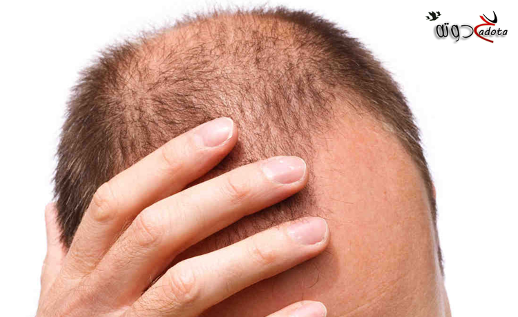 على ماذا يدل الصلع في الحلم؟