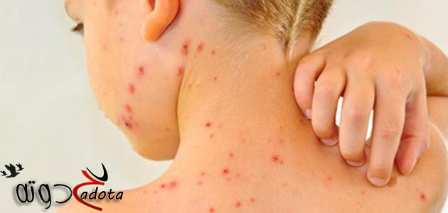 تفسير حلم الجدري في المنام