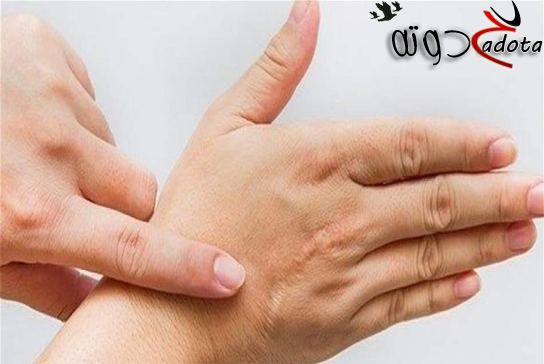 ما هو تفسير حلم الكي في المنام