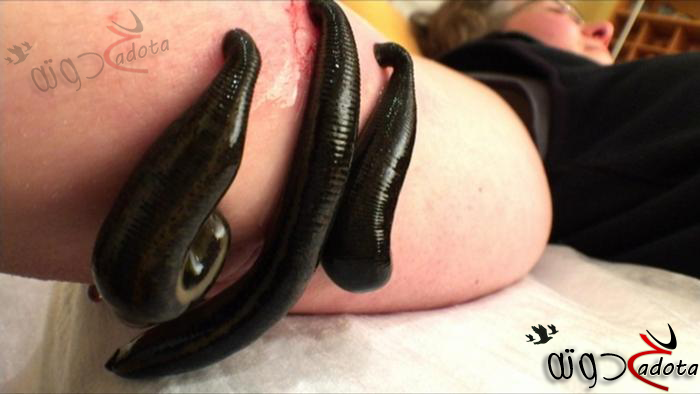 تفسير حلم دودة العلقة في المنام