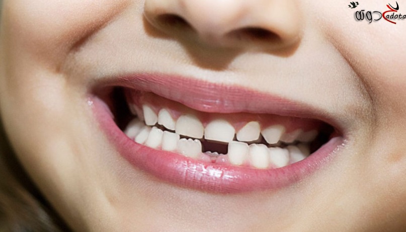 تفسير رؤية الضرس المثقوب في المنام