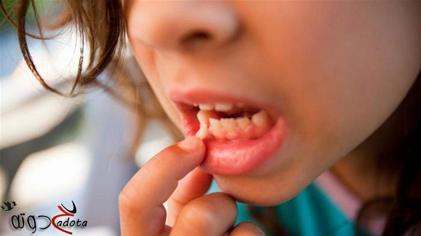 ما هو تفسير حلم تخلخل الاسنان في المنام لابن سيرين