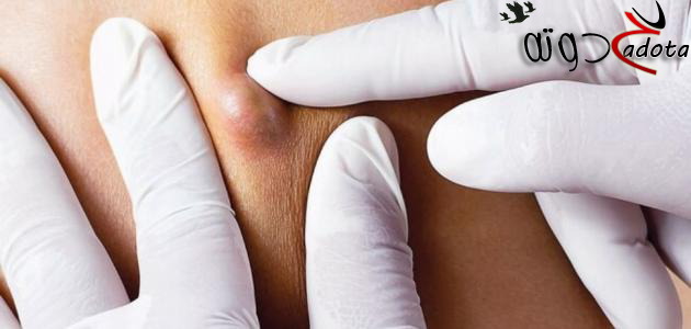 تفسير رؤية الكيس الدهني في المنام