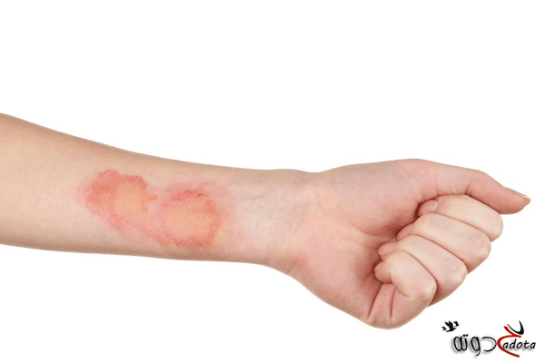 تفسير رؤية اثار حروق في المنام