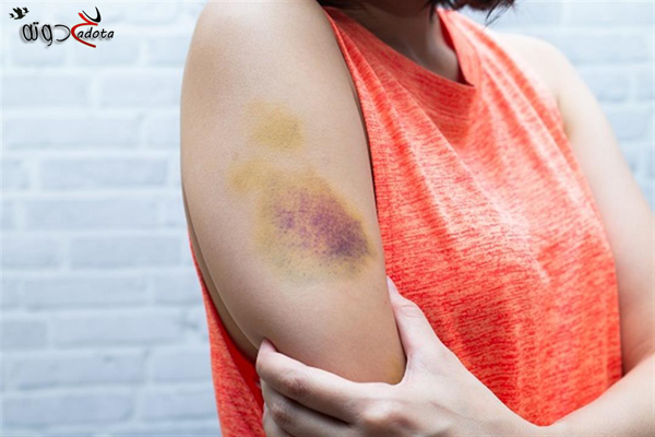 تفسير رؤية كدمات حمراء في المنام