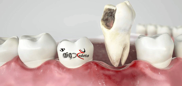 ما تفسير رؤية ضرس مسوس في المنام