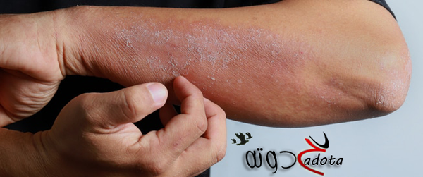 تفسير حلم المرض الجلدي في المنام