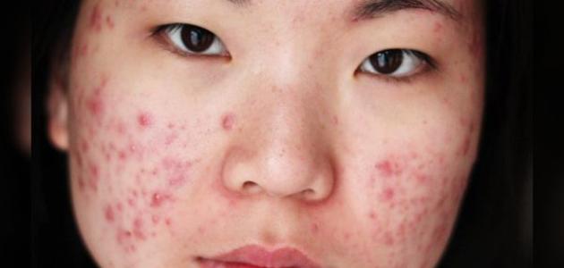 تفسير حلم حبوب في الوجه في المنام