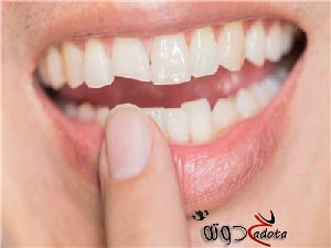 تفسير حلم رؤية كسر السن الأمامي في المنام