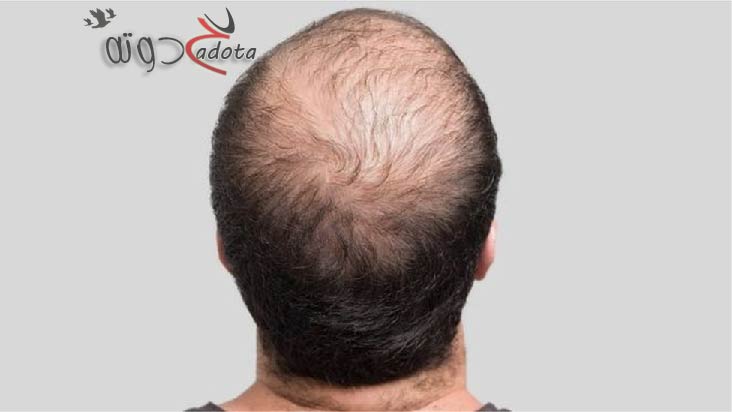 تفسير حلم رؤية أبي أصلع في المنام